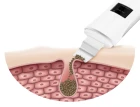 Peeling_kawitacyjny_BL309_15.jpg